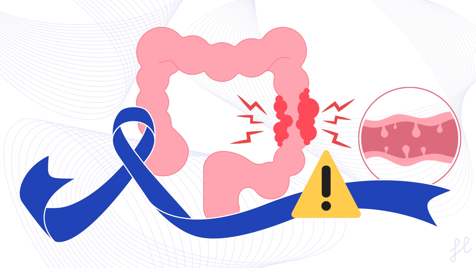 Colorectal Cancer